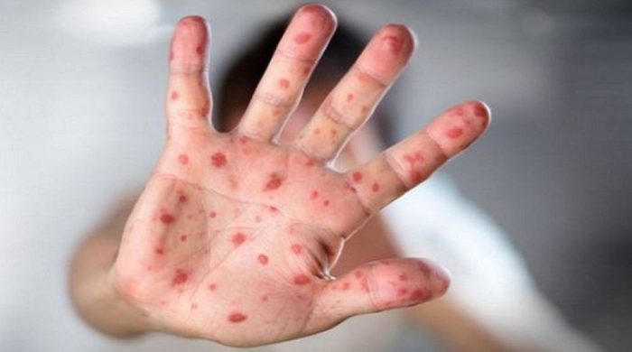 হামের উপসর্গ নিয়ে ২৬ দিনে ১৬৬ শিশুর মৃত্যু